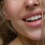 How long does lip filler bruising last?