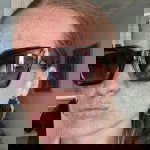 Woman with hyperpigmentation using retinol to fade her dark spots