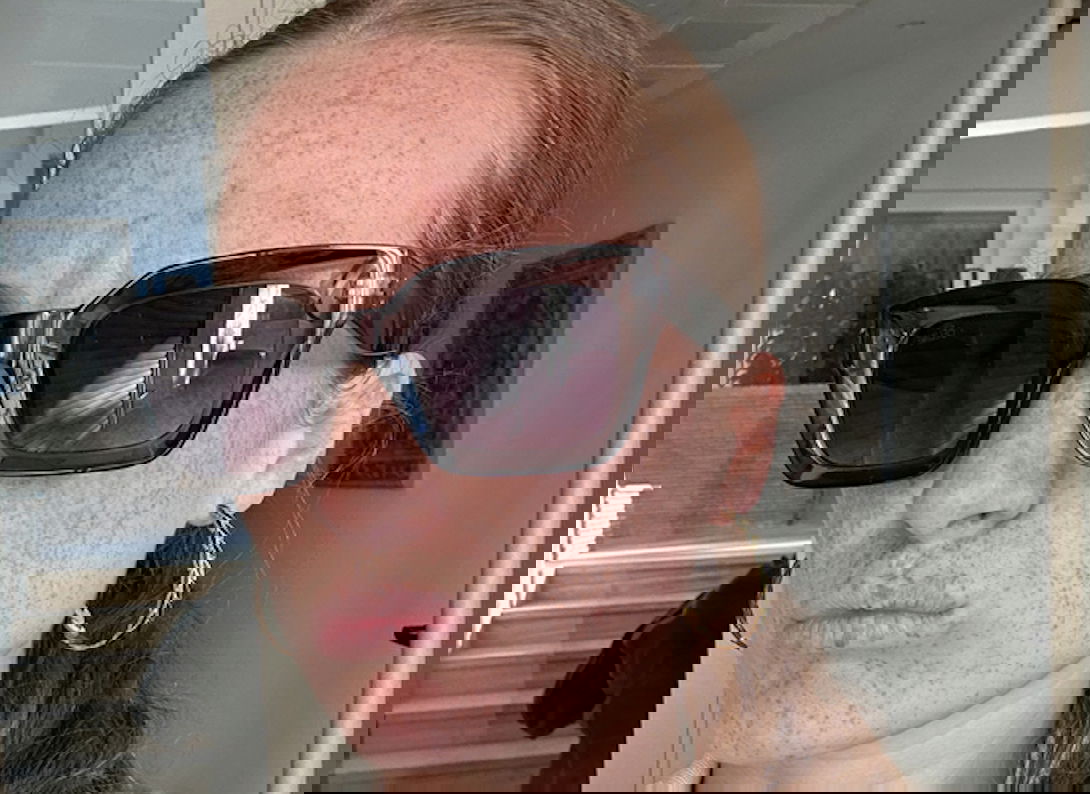 Woman with hyperpigmentation using retinol to fade her dark spots