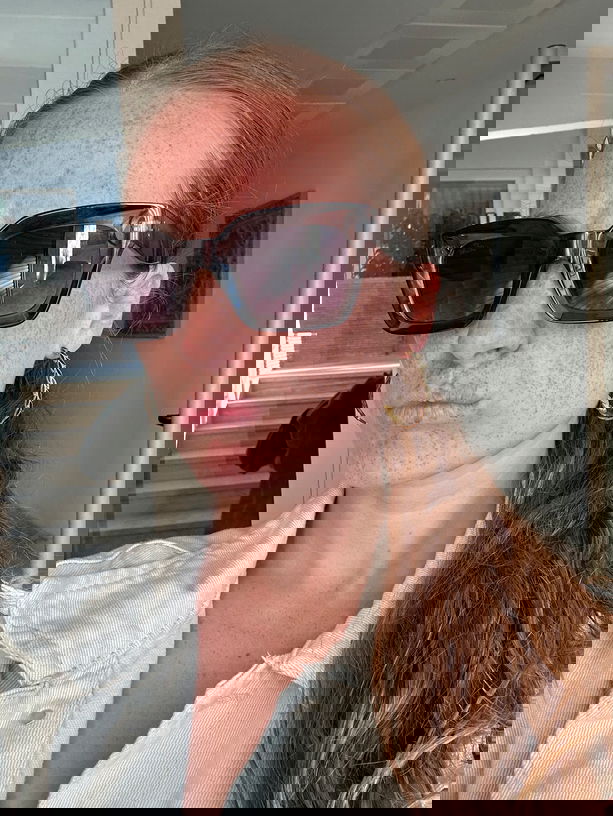 Woman with hyperpigmentation