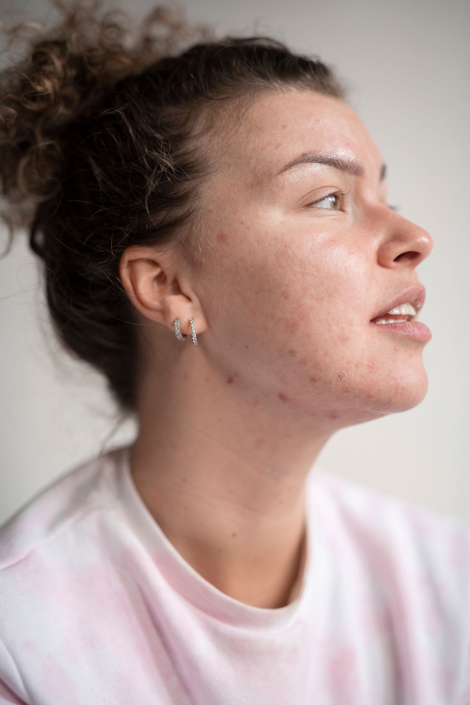 Woman with acne breakout