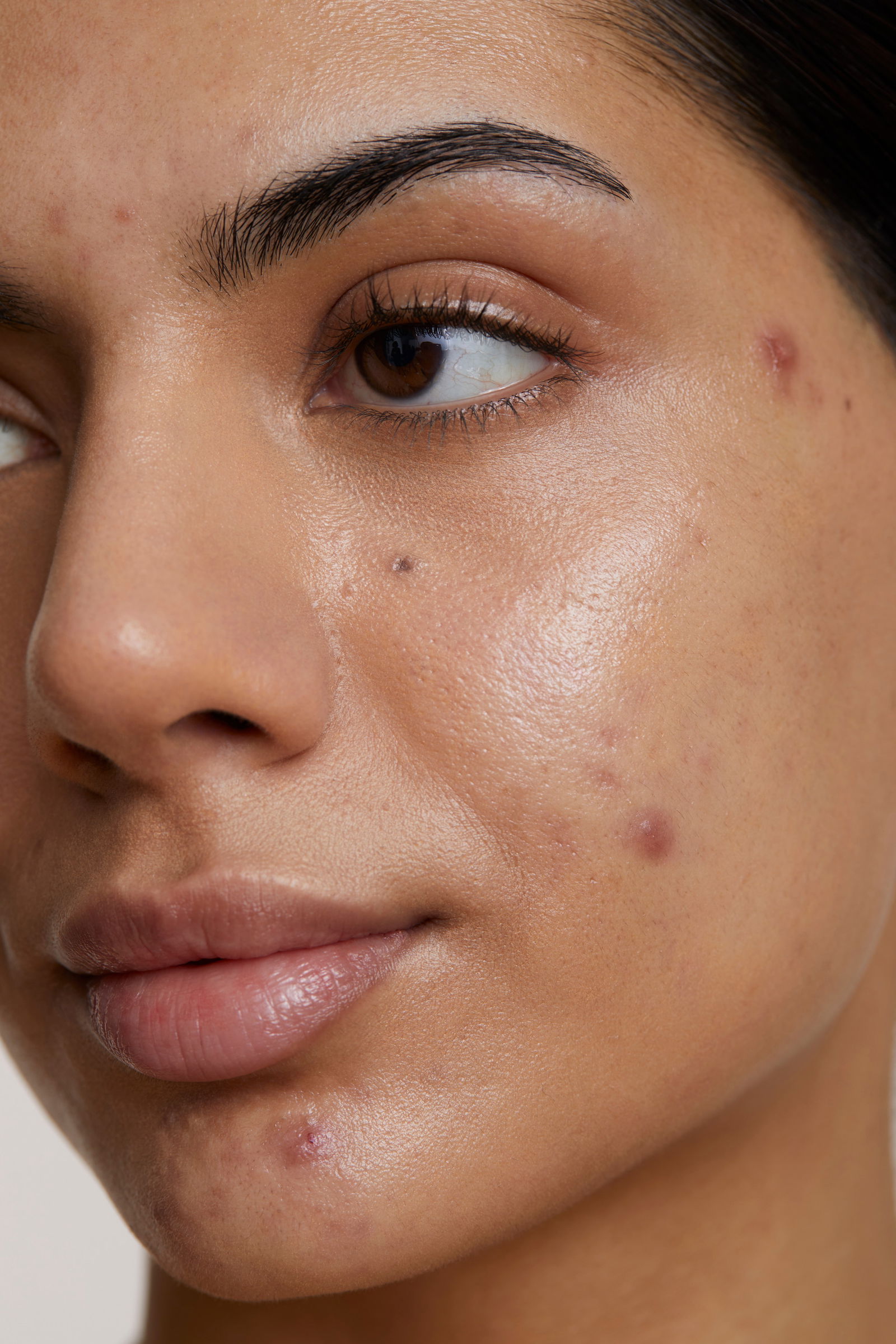 Woman with acne scarring showing the importance of treating acne scars retinol skin type