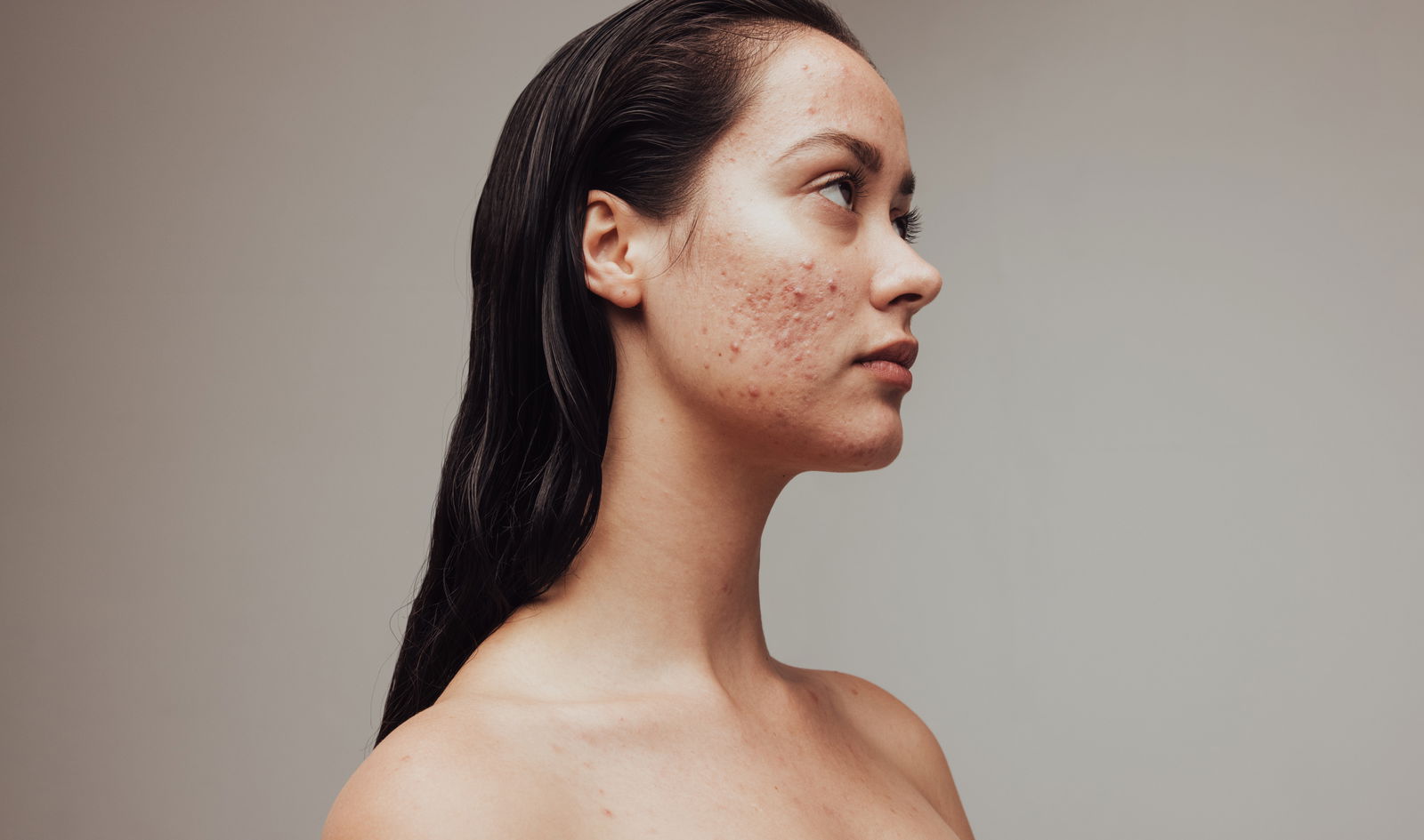 Woman with acne showing how to get rid of acne redness