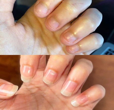nail growth