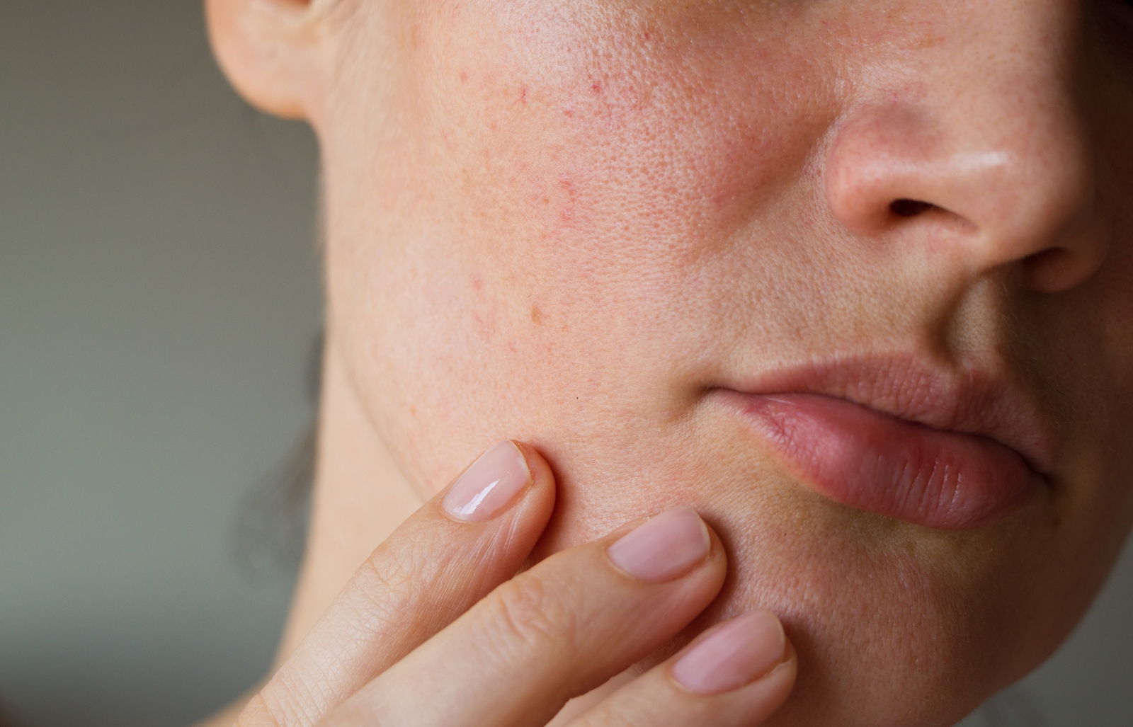 pores perioral dermatitis