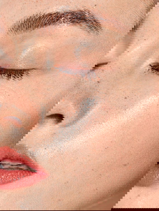 what is hyperpigmentation