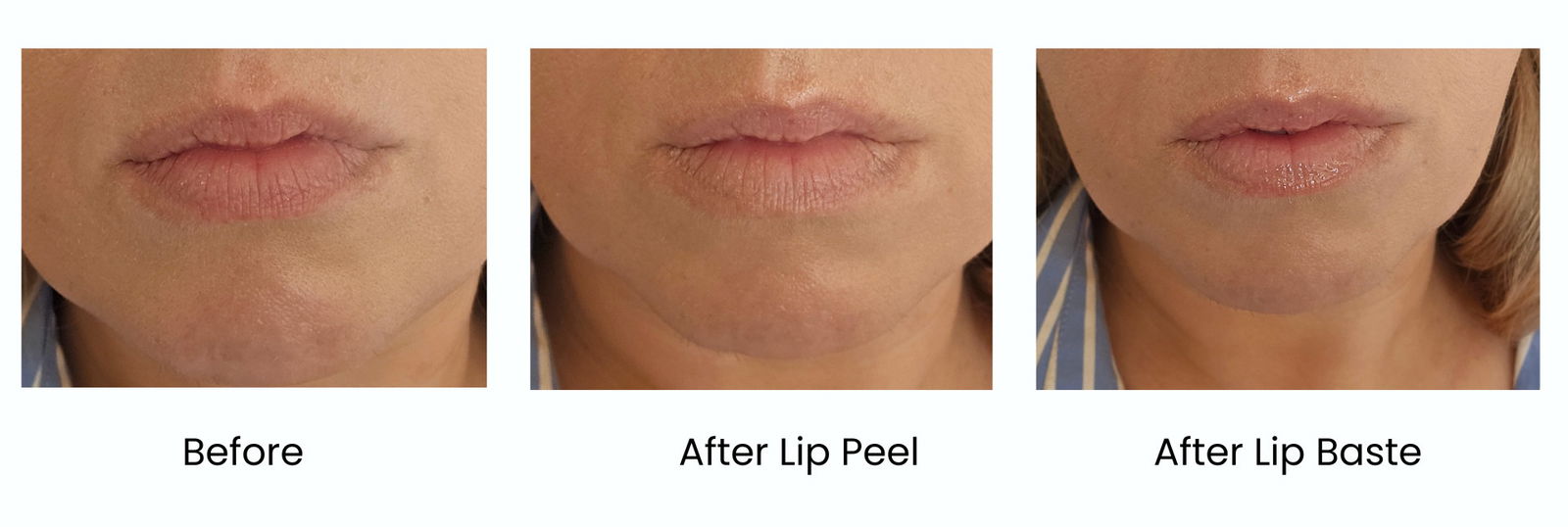 Dr Idriss Barrier Baste Lip Basting Duo before and after images