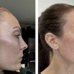 Hair growth results of a woman before and after using CurrentBody's LED Hair Growth Helmet