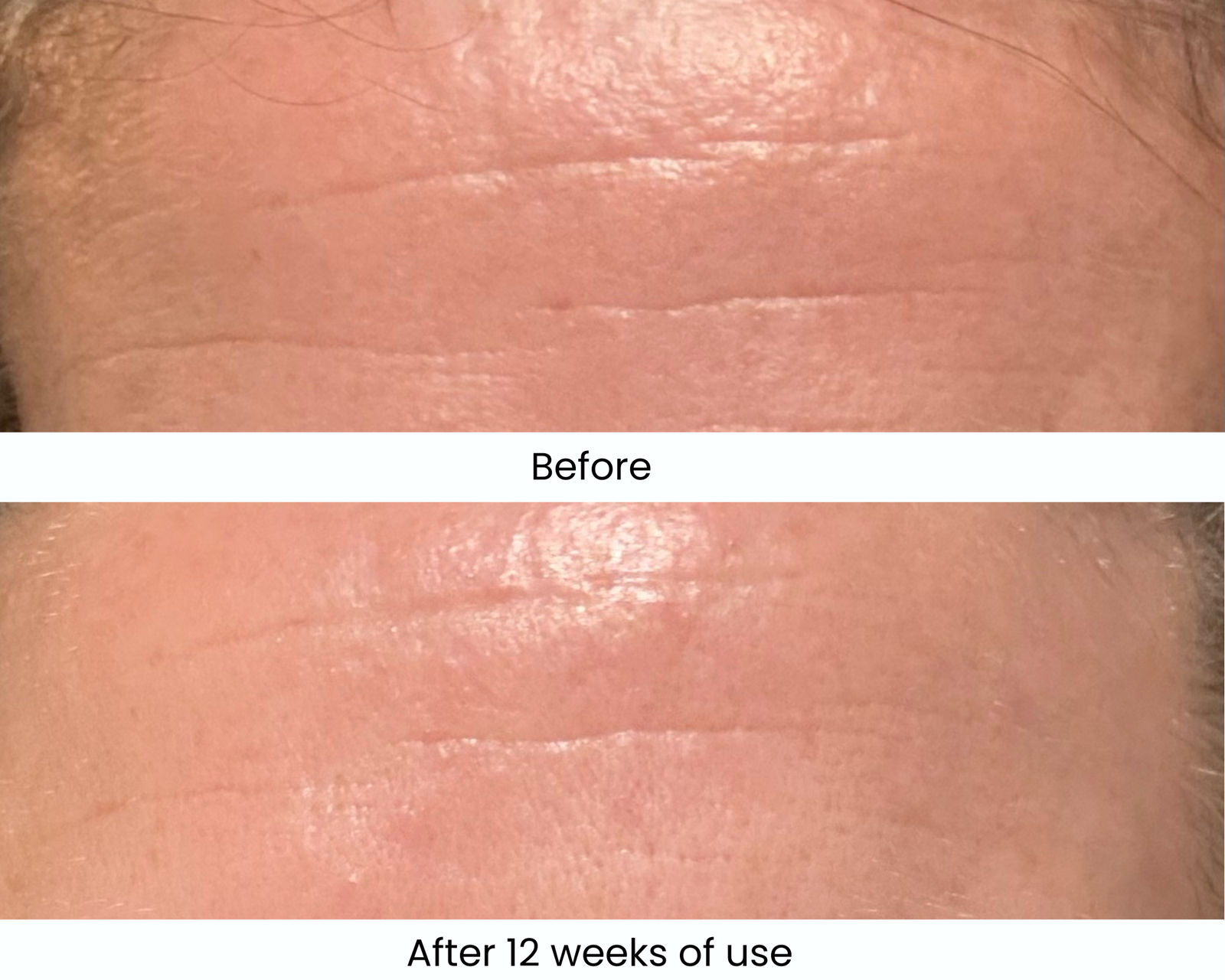 Before and after 12 weeks of use Medik8 Crystal Retinal