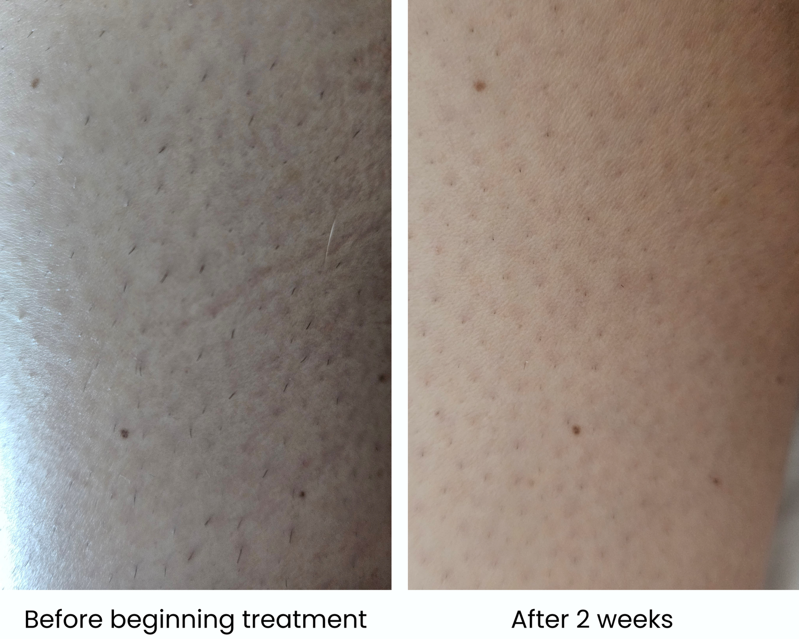 Ulike before and after hair removal results